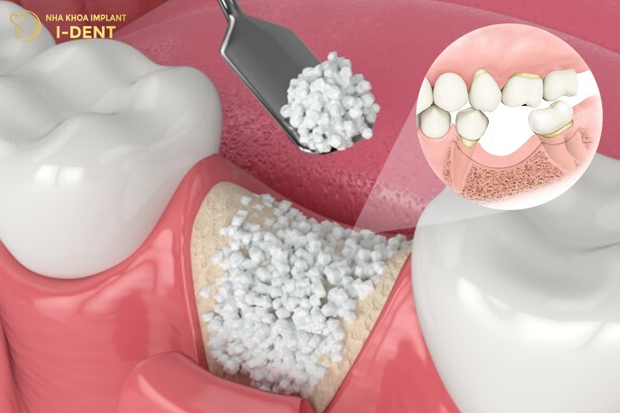 tiêu xương hàm có trồng răng được không