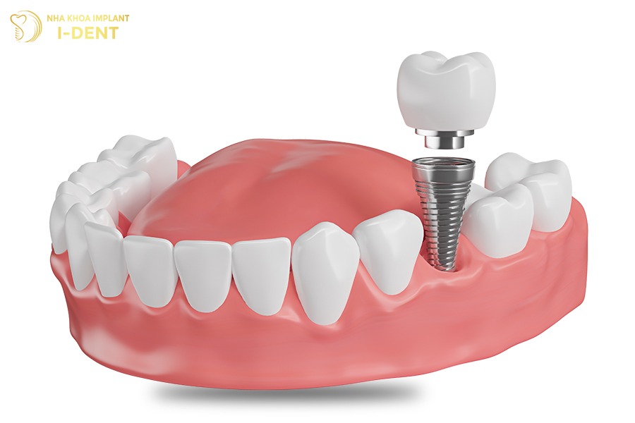 Trồng răng hàm bị sâu bằng phương pháp cấy ghép implant
