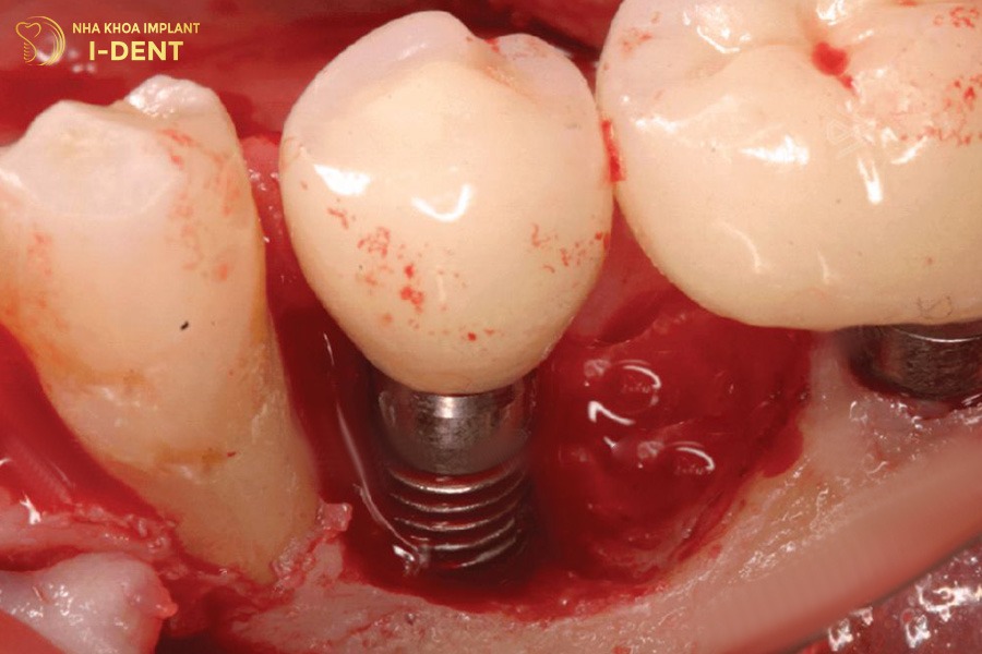 Chảy máu kéo dài sau phẫu thuật