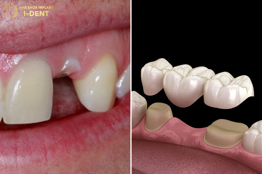 răng bị gãy chân