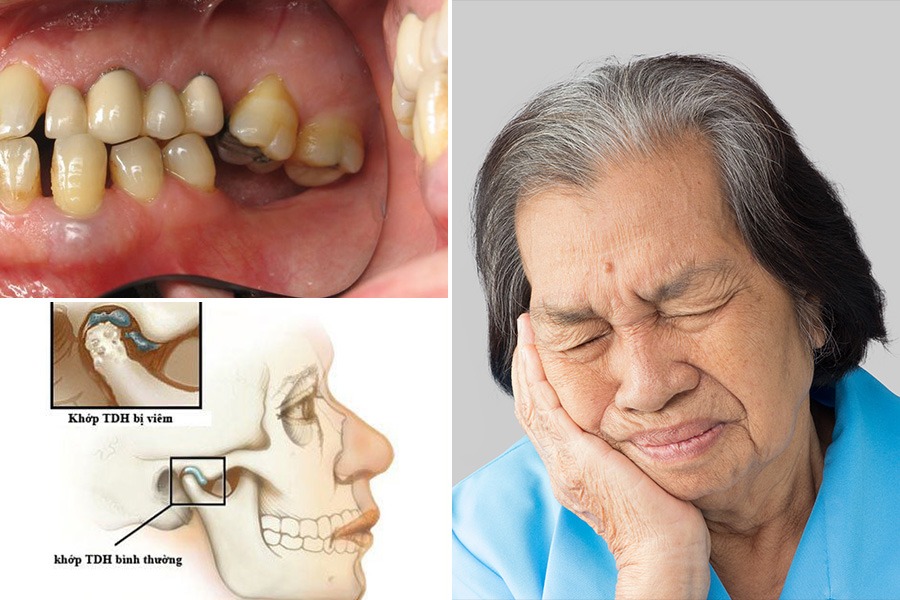 Mất răng hàm có làm hóp má không 