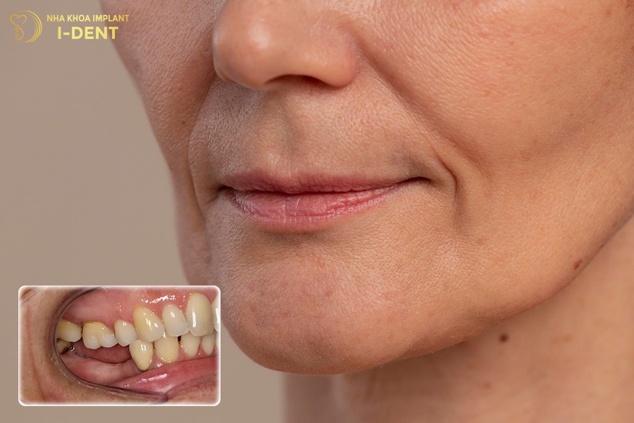 mất răng hàm gây hóp má