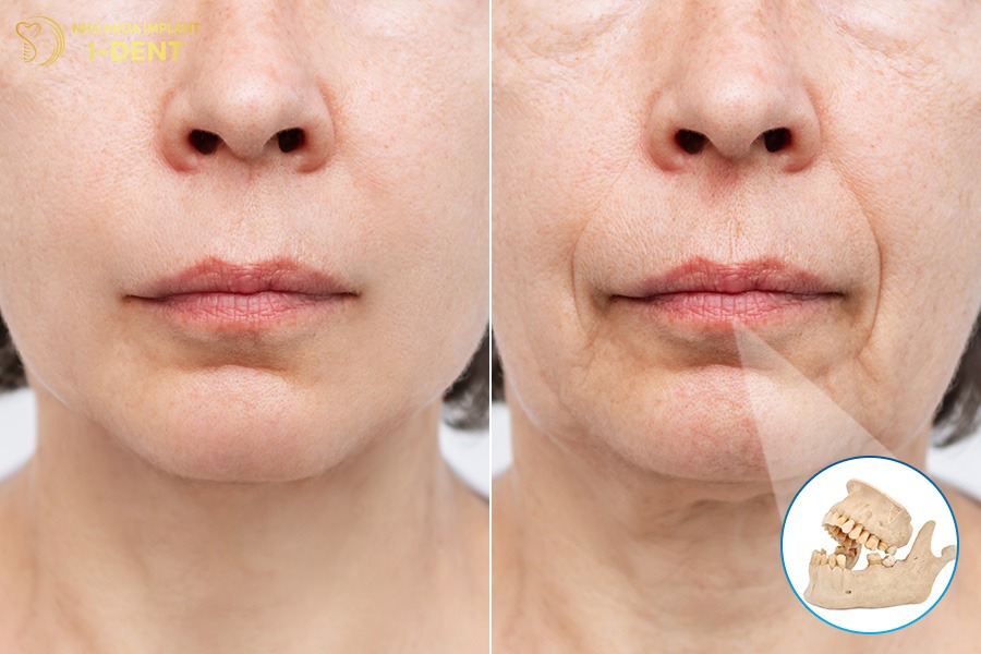 không trồng răng có sao không