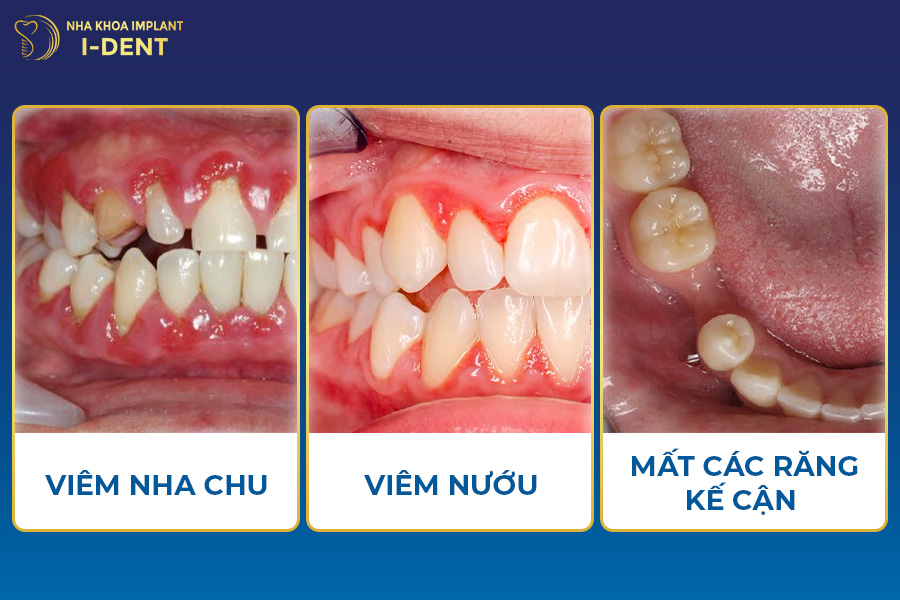 mất răng không trồng lại có sao không