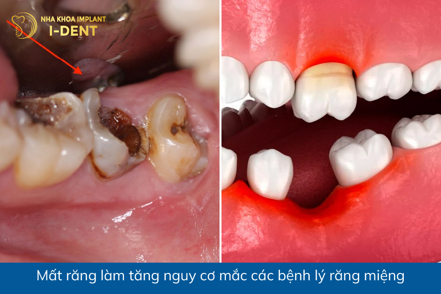 mất răng thì phải làm sao