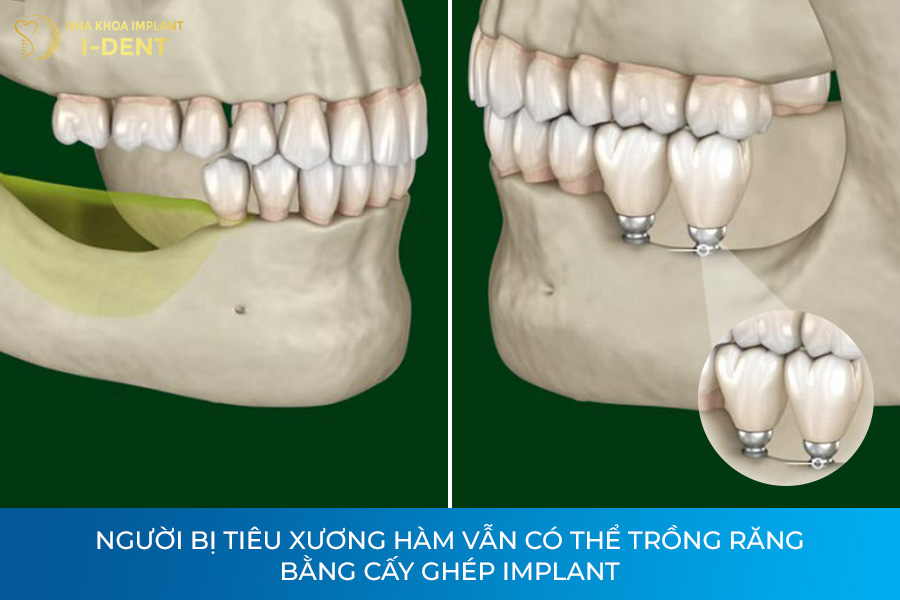 trồng răng khi bị tiêu xương hàm