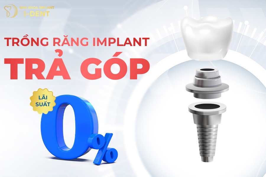 cấy ghép implant trả góp