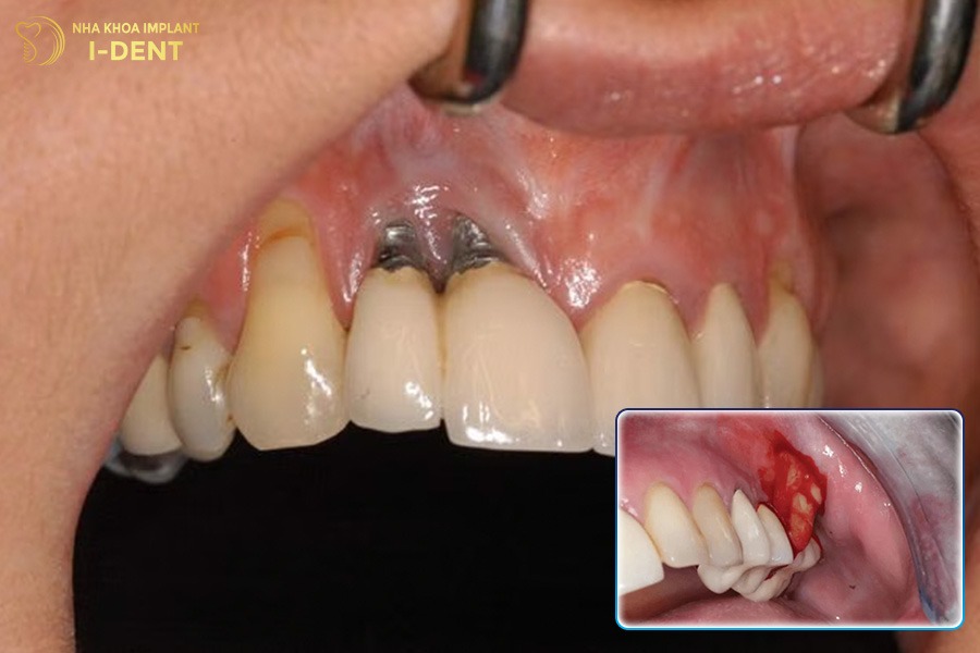 Nhiễm trùng vùng trồng răng Implant