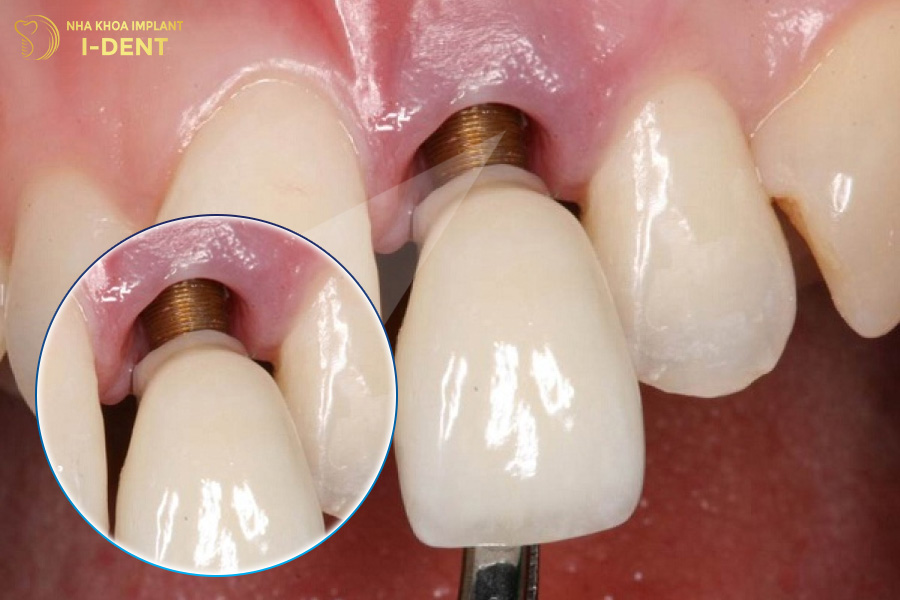 Răng Implant bị lung lay