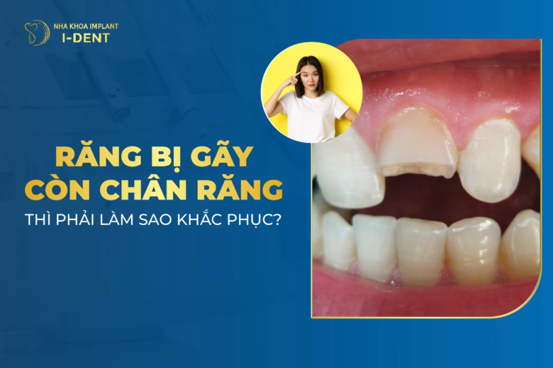 Răng gãy còn chân: Nguyên nhân, tác hại và cách xử lý