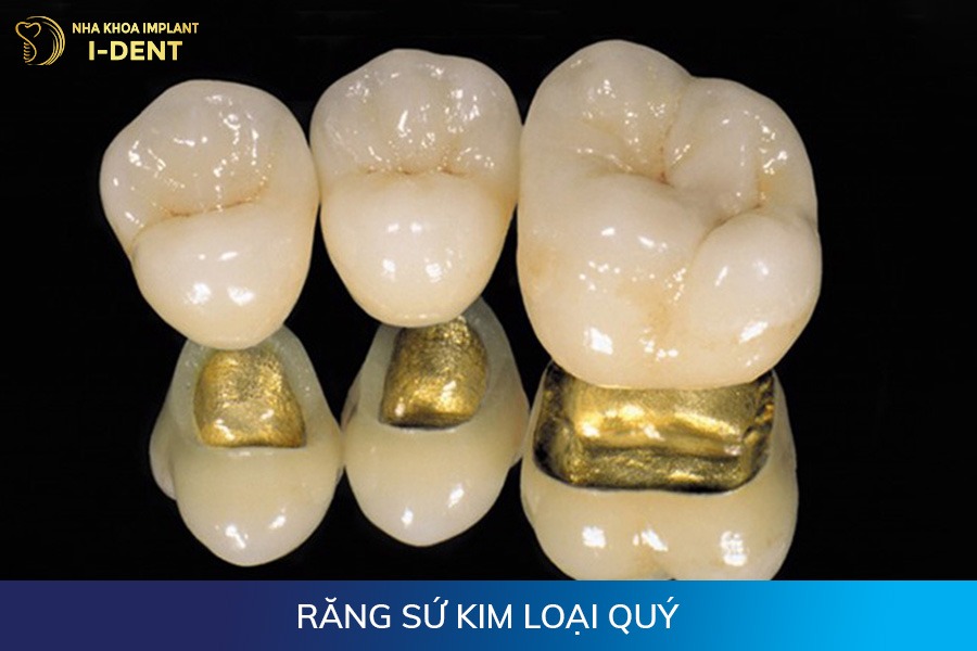 có mấy loại răng sứ