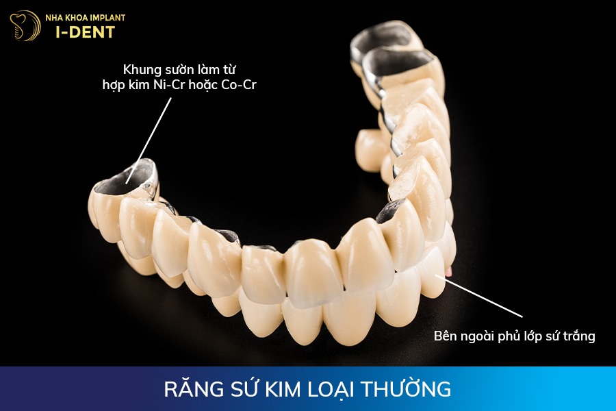 các loại răng sứ