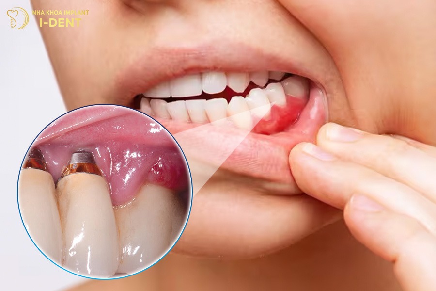 Sưng đau kéo dài