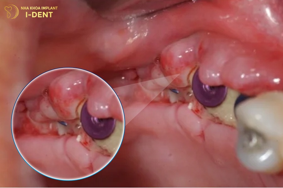Tổn thương các mô lân cận
