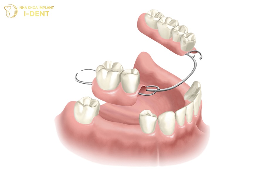 trồng răng phục hình