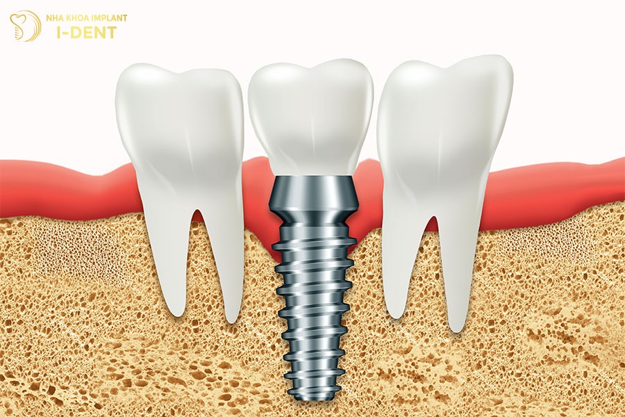 trồng răng cố định