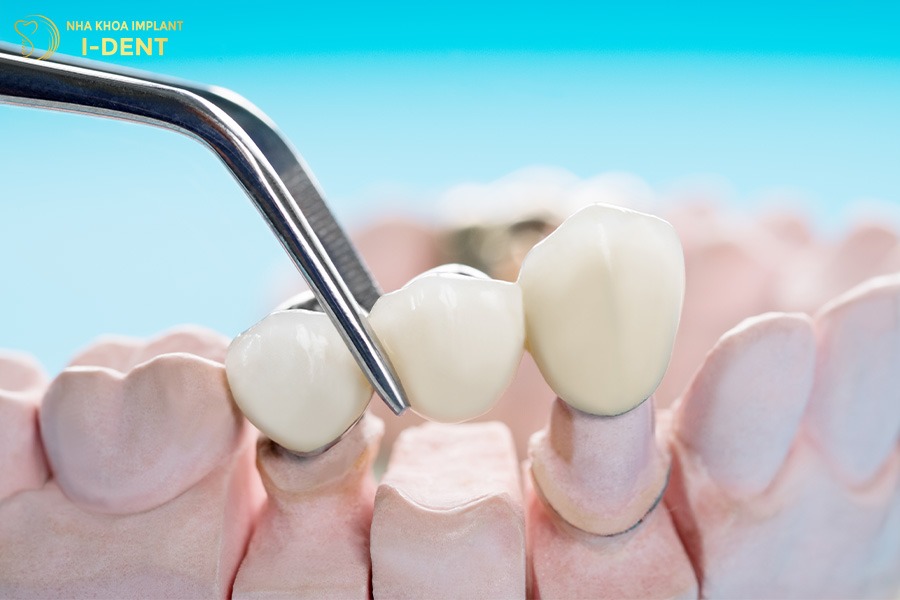 trồng răng giả cố định