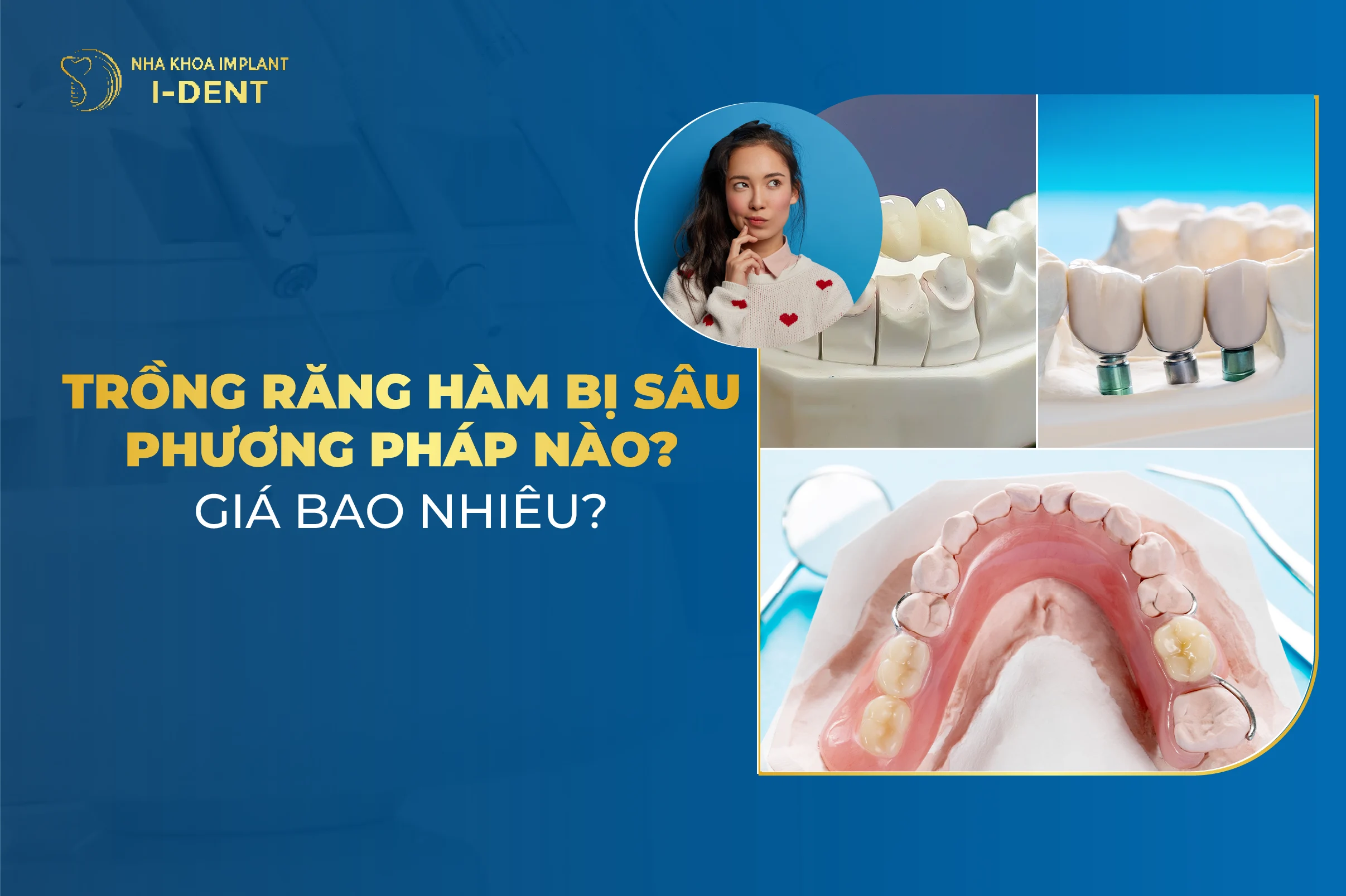 Trồng răng hàm bị sâu giá bao nhiêu? Phương pháp nào tốt?