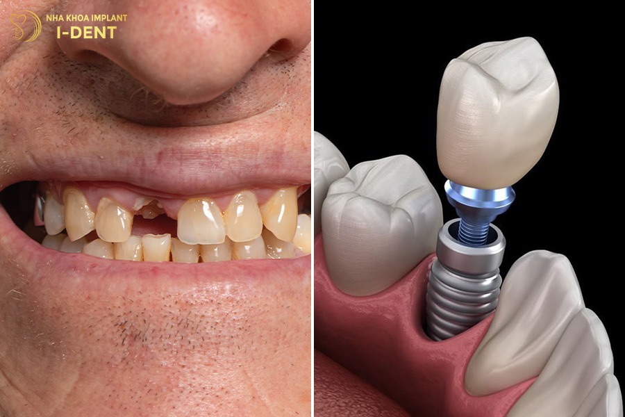 răng bị gãy đôi