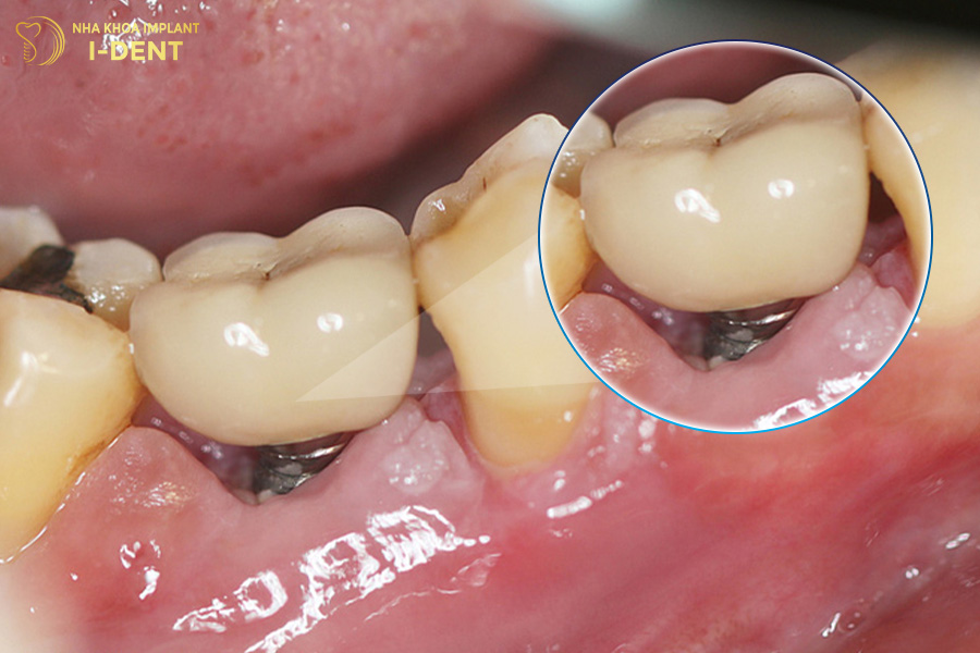 Viêm quanh trụ Implant