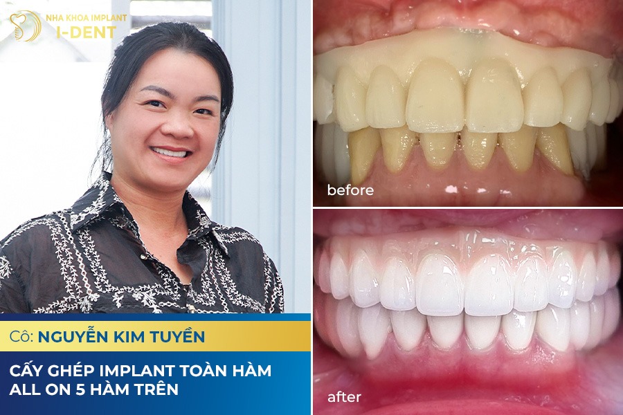 hình ảnh khách hàng trồng răng phục hình tại nha khoa I-Dent 
