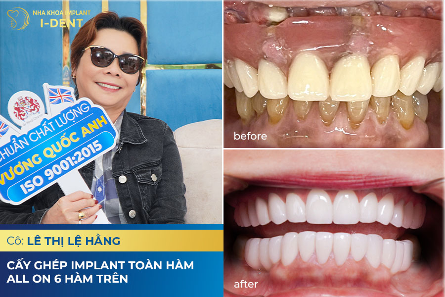 Trồng răng phục hình tại nha khoa I-Dent