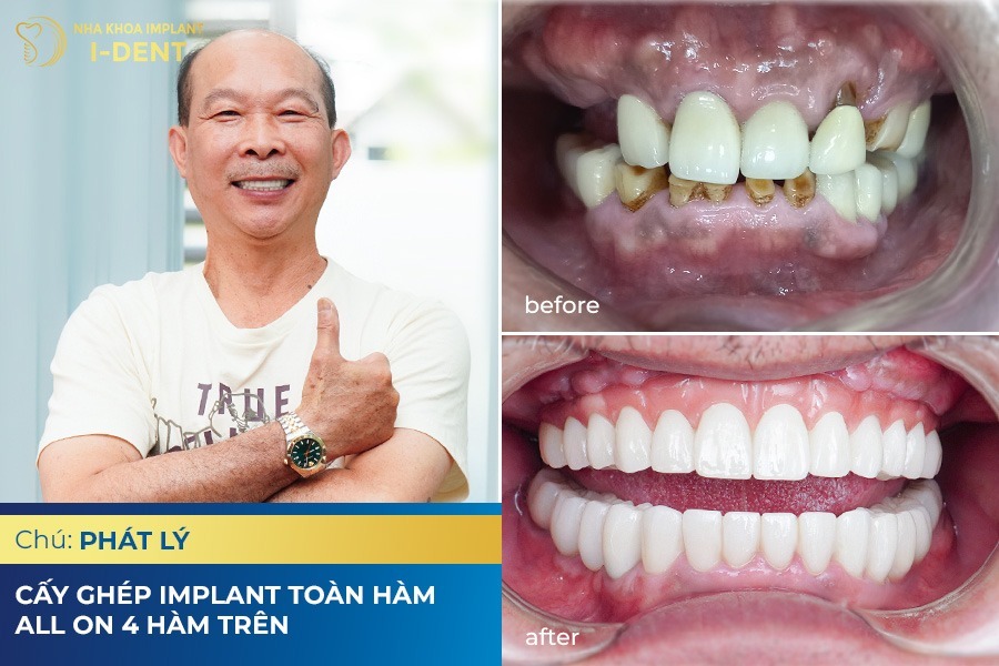 trồng răng là gì