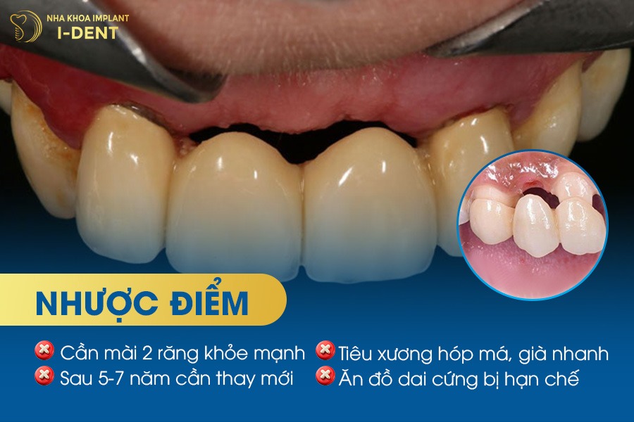 trồng răng hàm bao nhiêu tiền