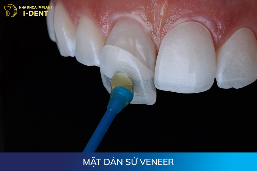 các loại răng sứ trên thị trường