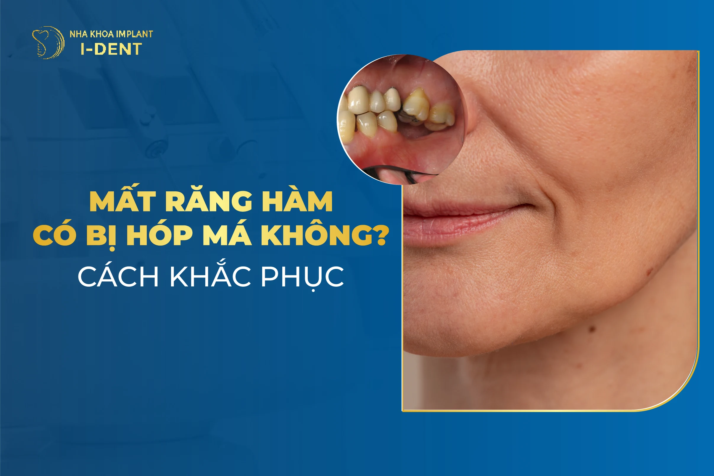 Mất răng hàm có bị hóp má không? Cách khắc phục hiệu quả