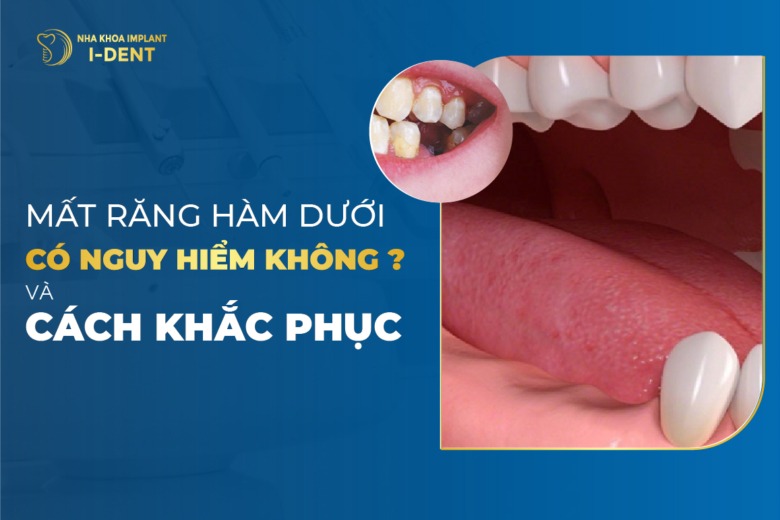 Mất răng hàm dưới gặp biến chứng gì? Phương pháp khắc phục