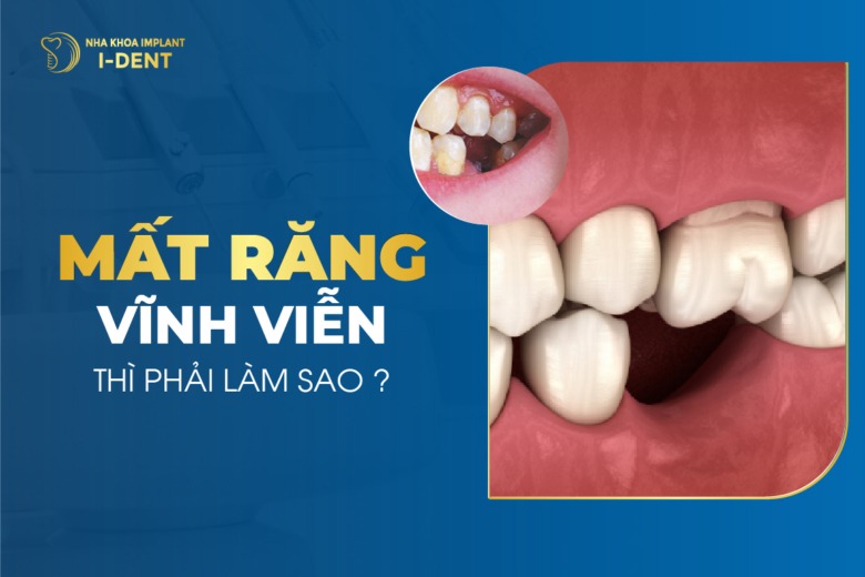 Mất răng vĩnh viễn nên làm gì? Cách phòng ngừa mất răng