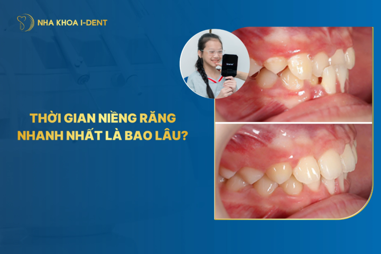 thời gian niềng răng nhanh nhất là bao lâu