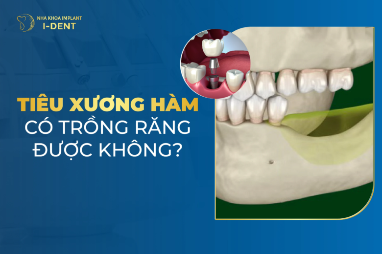 Tiêu xương hàm có trồng răng được không?
