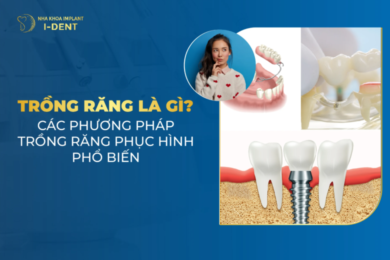 Trồng răng phục hình là gì? Những điều cần lưu ý