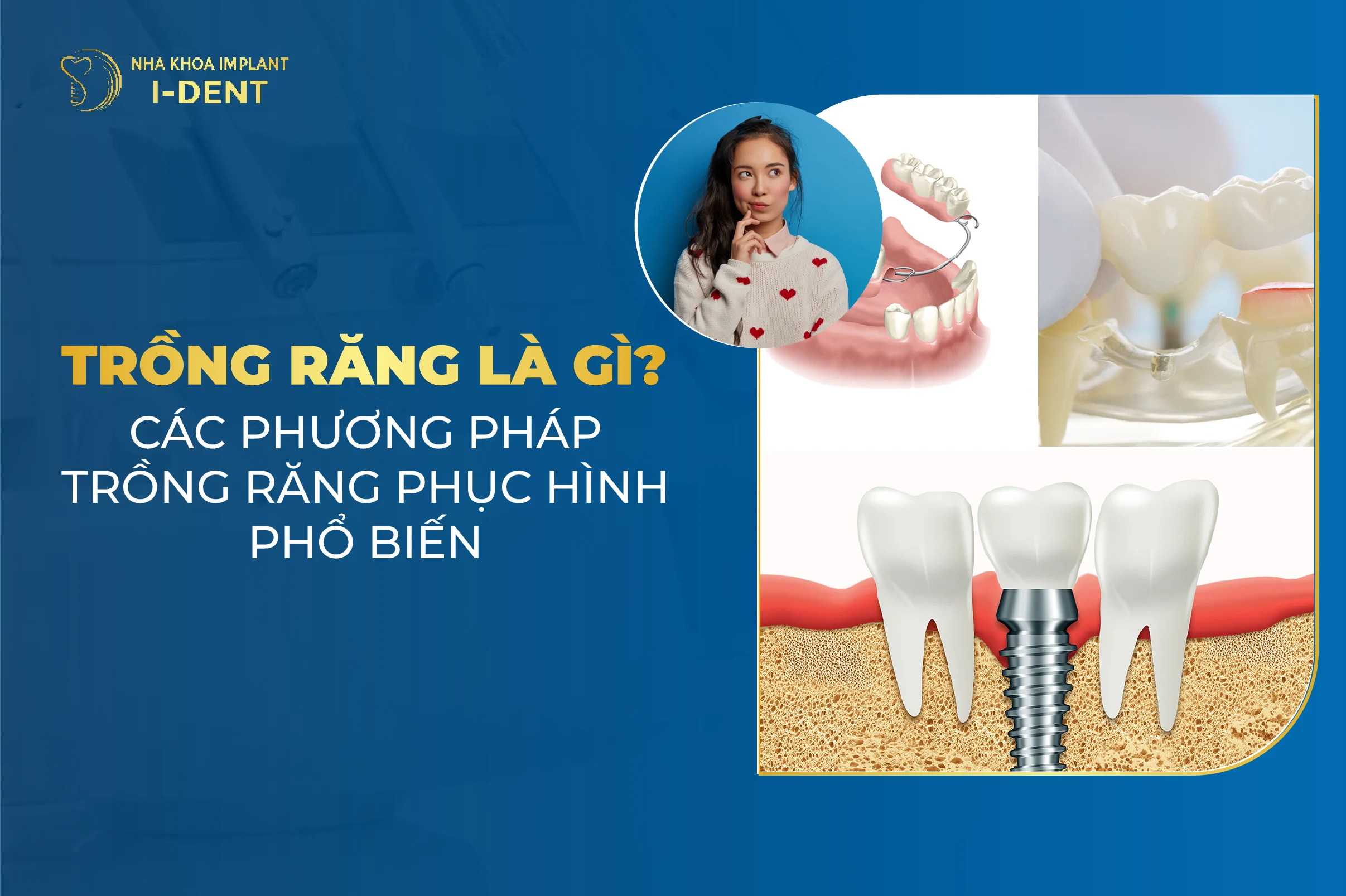 Trồng răng phục hình là gì? Những điều cần lưu ý