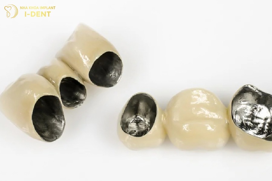 nên bọc răng sứ loại nào