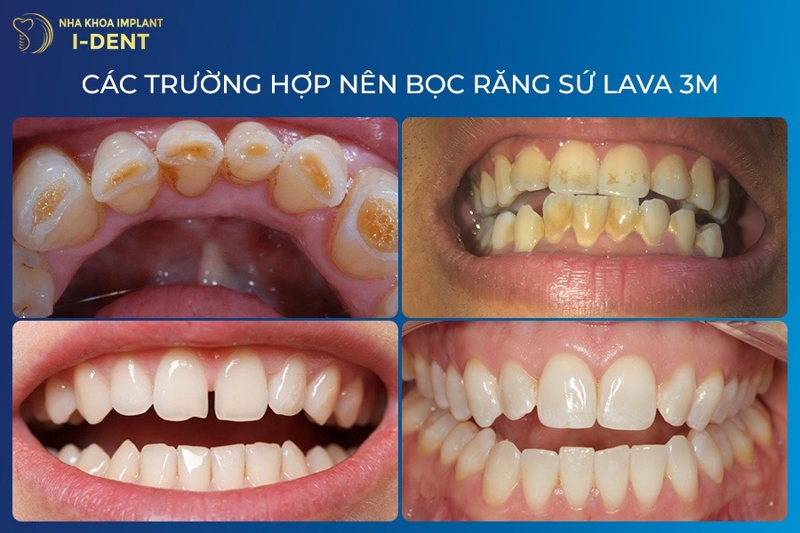 răng sứ 3M Lava Plus