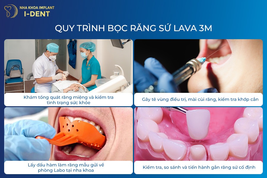 răng sứ Lava Plus 3M