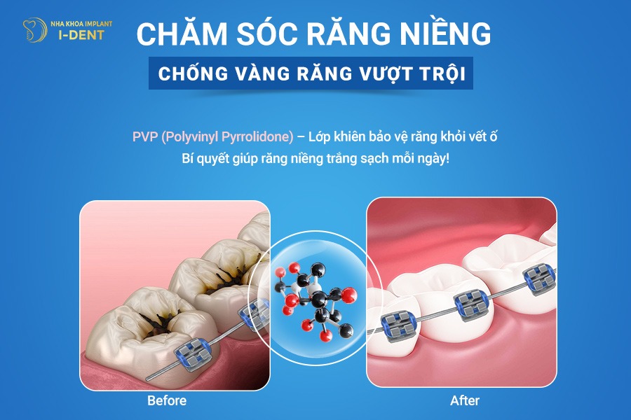 Nước súc miệng Waterine Ortho có chứa thành phần PVP