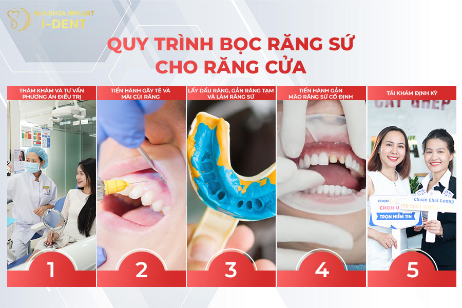 Quy trình bọc răng sứ cho răng cửa