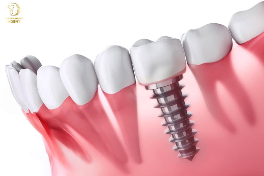 Phương pháp trồng implant