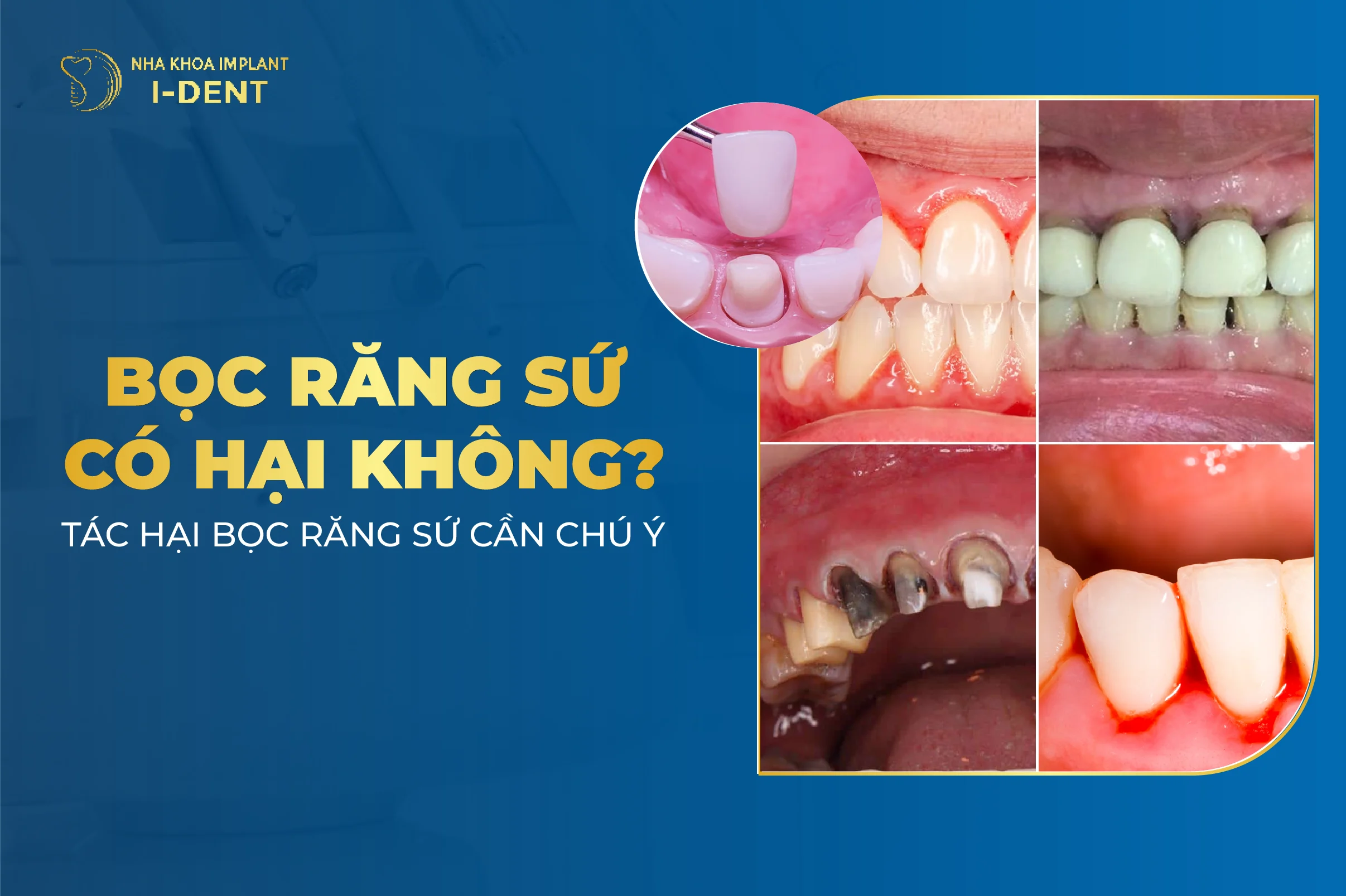 Bọc Răng Sứ Có Hại Không? 11 Tác Hại Cần Chú Ý