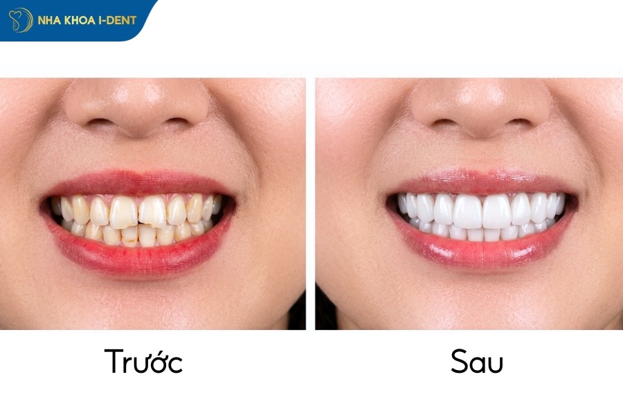 bọc răng cửa bị mẻ bao nhiêu tiền