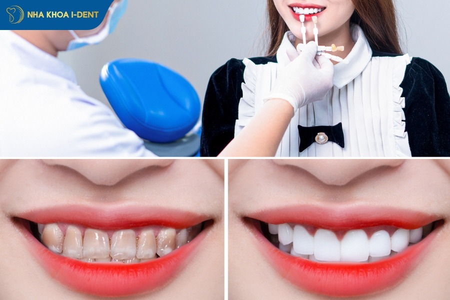 giá bọc sứ răng cửa