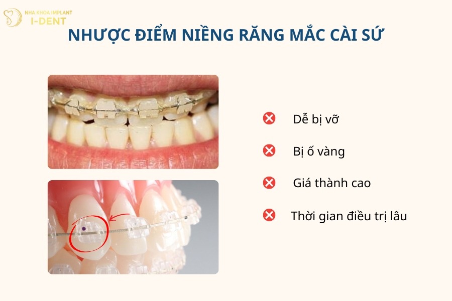 ưu nhược điểm của niềng răng mắc cài sứ