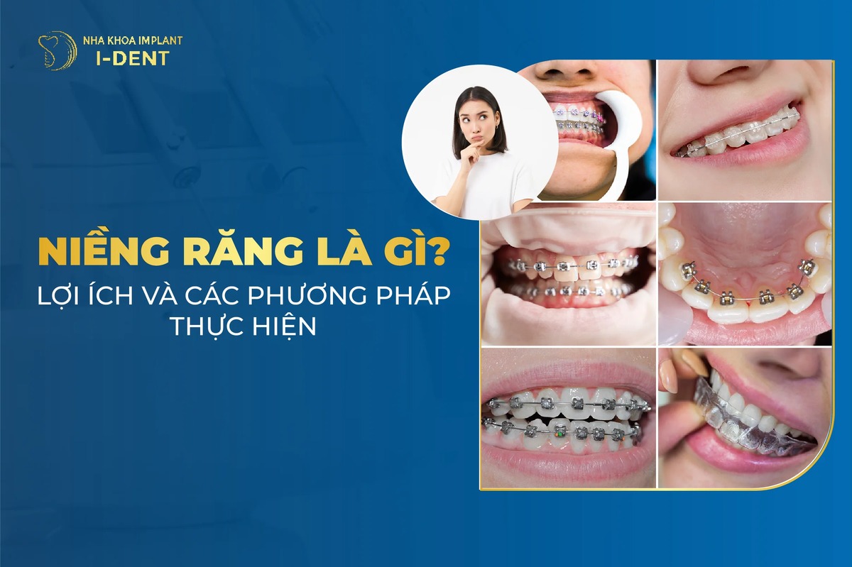 Niềng răng: Giá, Các Phương Pháp và Lợi ích