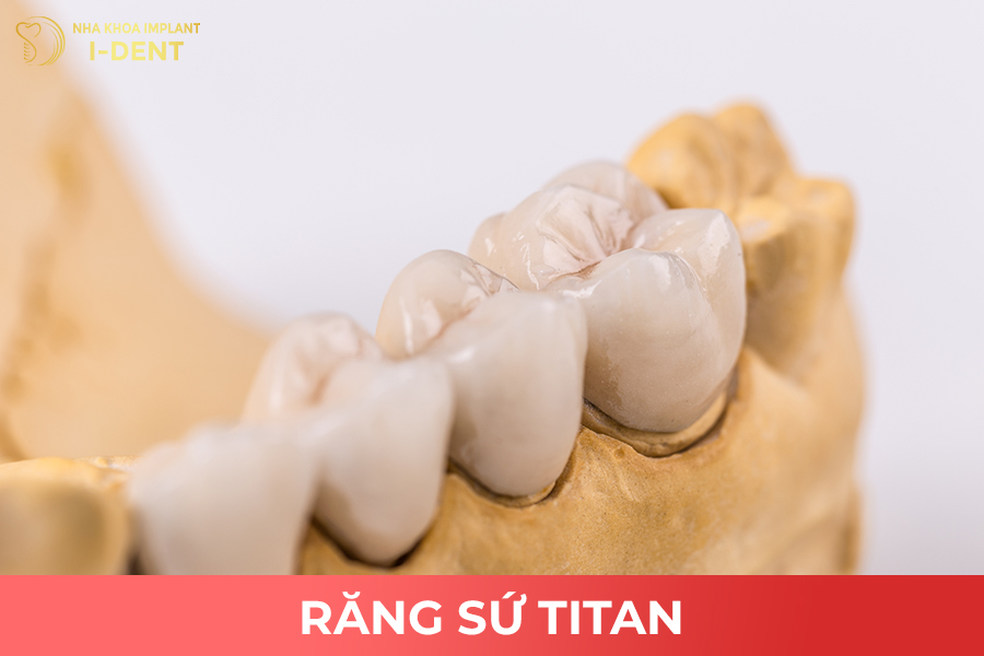 Rắng sứ titan