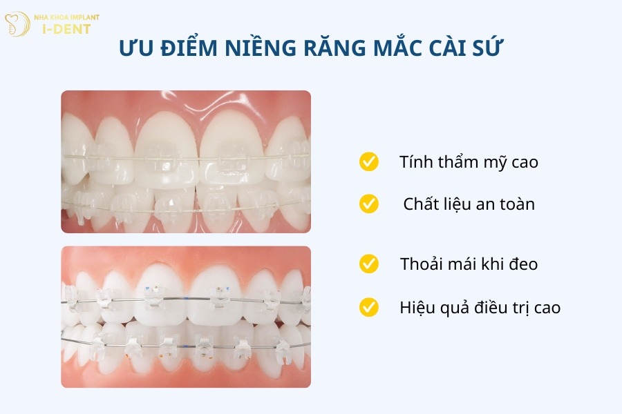 các loại niềng răng mắc cài sứ