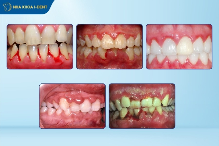 Bị viêm nướu răng phải làm sao